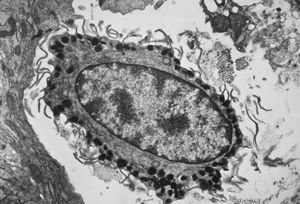 M,11y. | mast cell - skin M,11y. | mast cell - skin